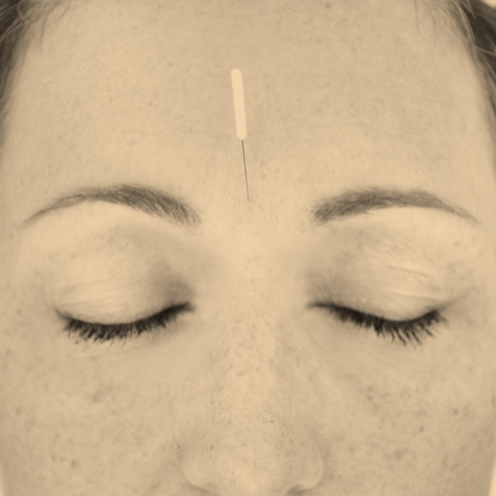 cosmetic acupuncture 1