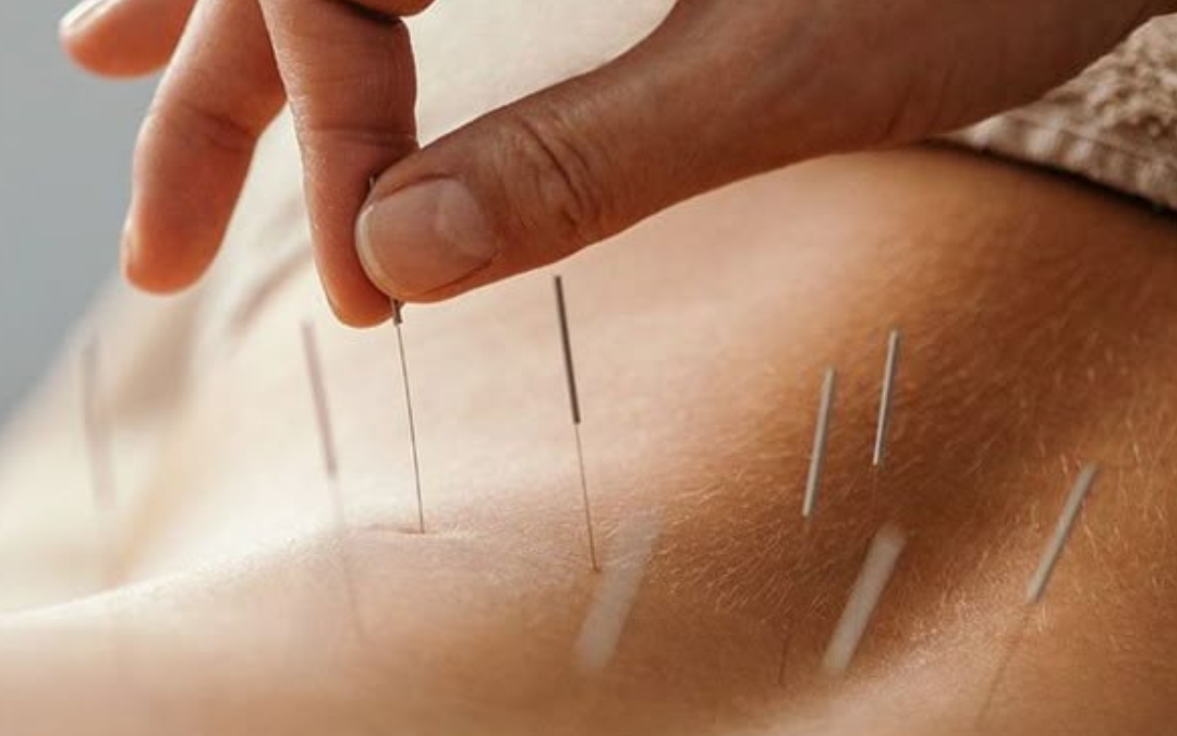 Acupuncture for Mental Health & Well-Being